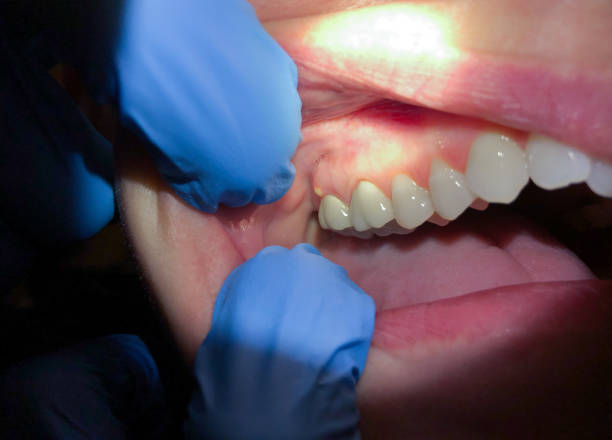 Best Broken or Chipped Tooth Repair in Oakwood, IL